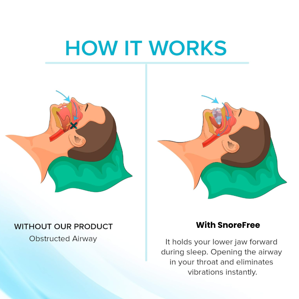 SnoreFree - Anti Snore & Deep Sleep Device